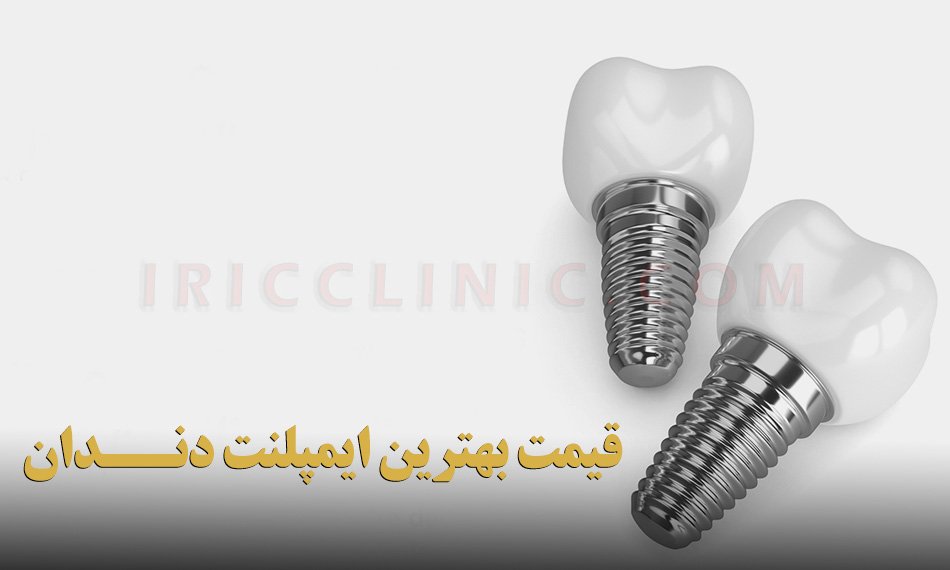 قیمت ایمپلنت دندان 1402