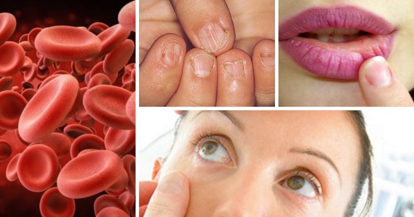 قرص آهن یا قرص فولیک اسید؟ تأثیرگذاری روی کمخونی