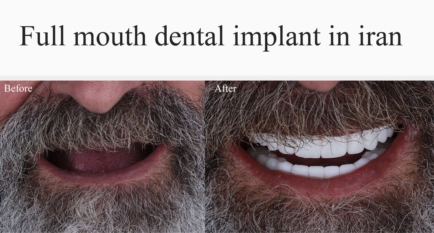 dental implant in iran