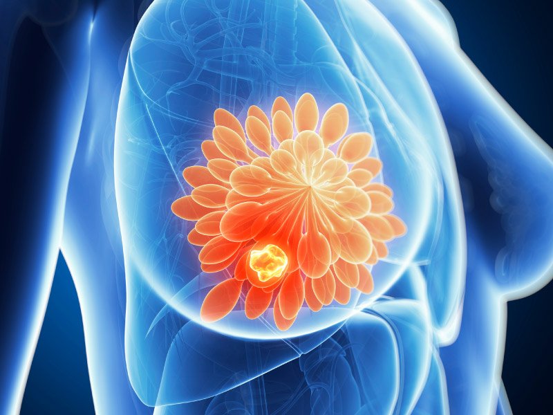 پروتز سینه بعد از سرطان پستان