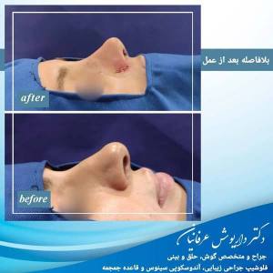 جراحی بینی در مشهد