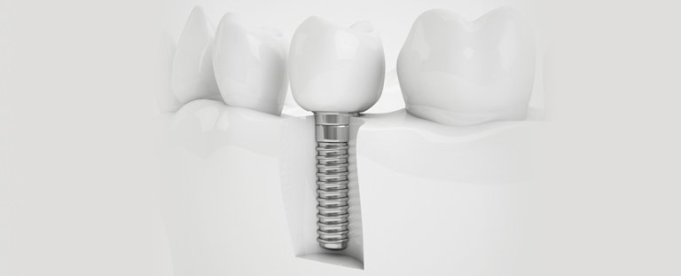 عوامل موثر بر قیمت ایمپلنت دندان