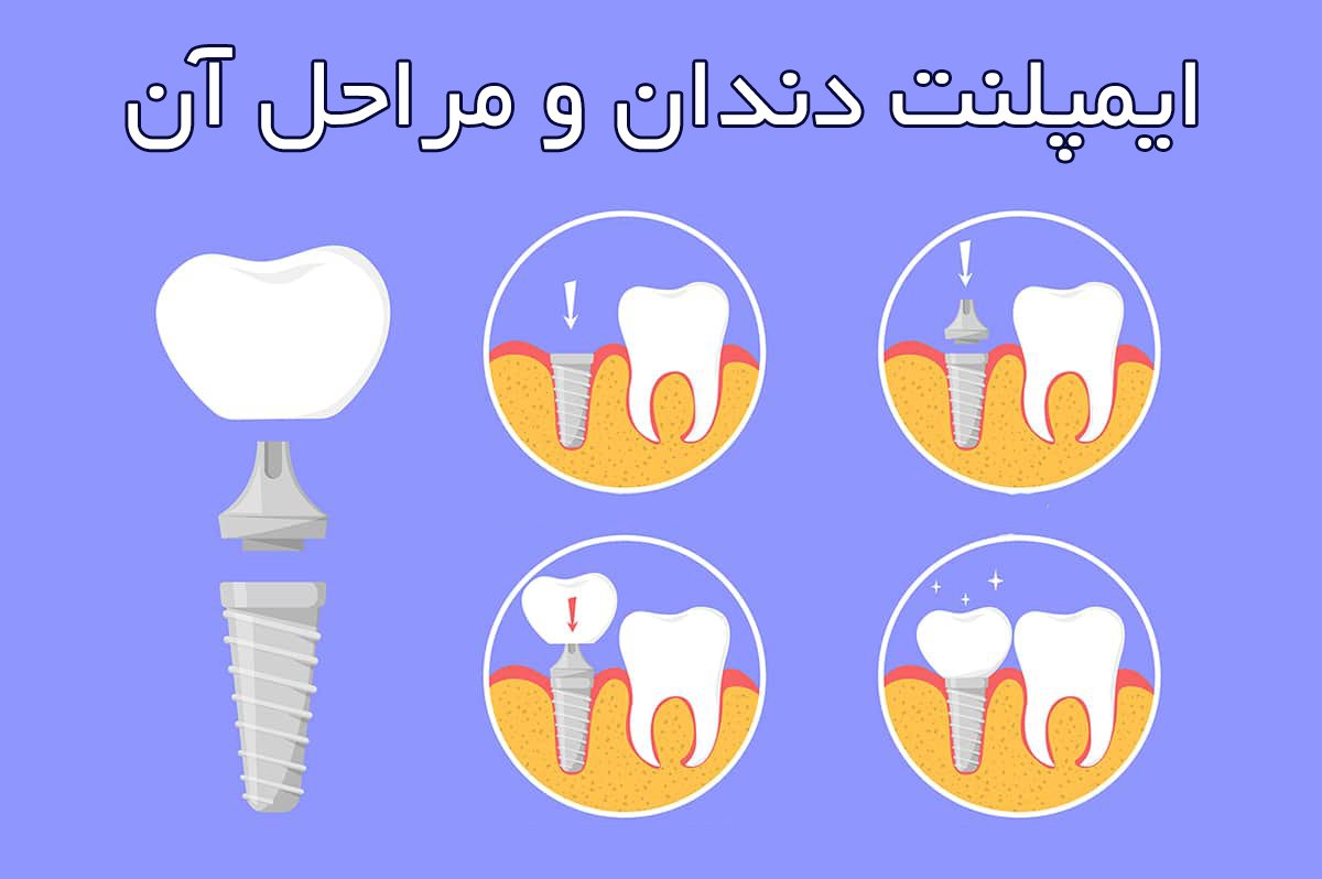 ایمپلنت دندان و مراحل آن