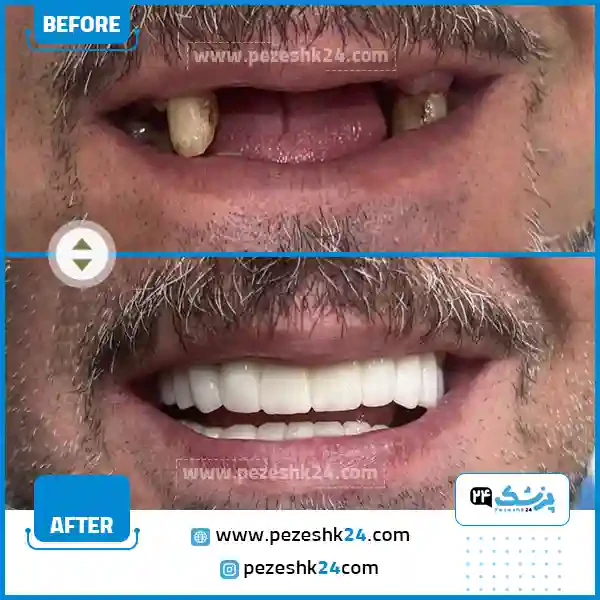 قبل و بعد ایمپلنت دندان در مشهد