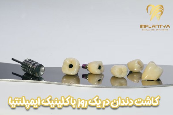 ایمپلنت کامل دندان در یک روز - کلینیک ایمپلنتیا