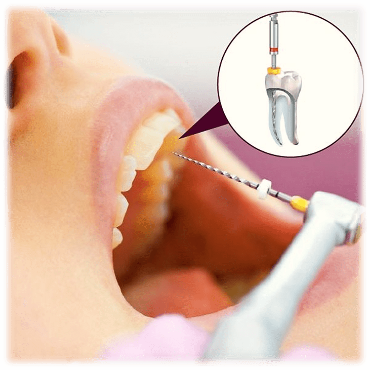 کاربردهای دستگاه روتاری در دندانپزشکی - تجهیزات دندانپزشکی فیروز دنتال