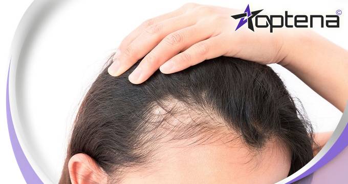 روش های پزشکی برای جلوگیری از ریزش مو