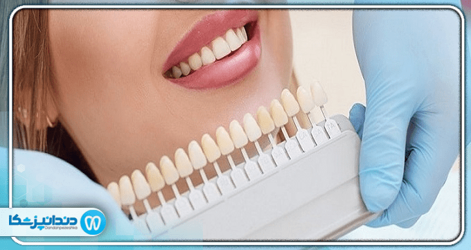ماندگاری و طول عمر کامپوزیت دندان چقدر است؟