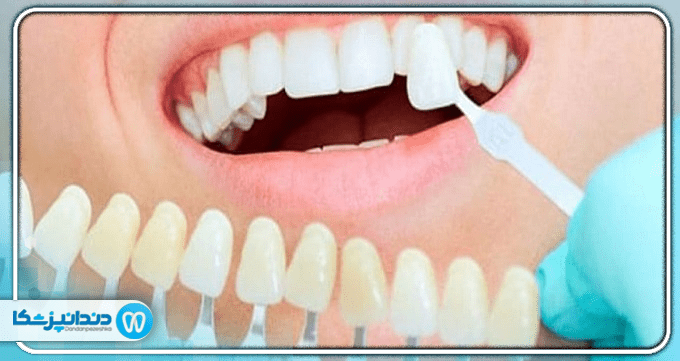 مراحل انجام کامپوزیت دندان
