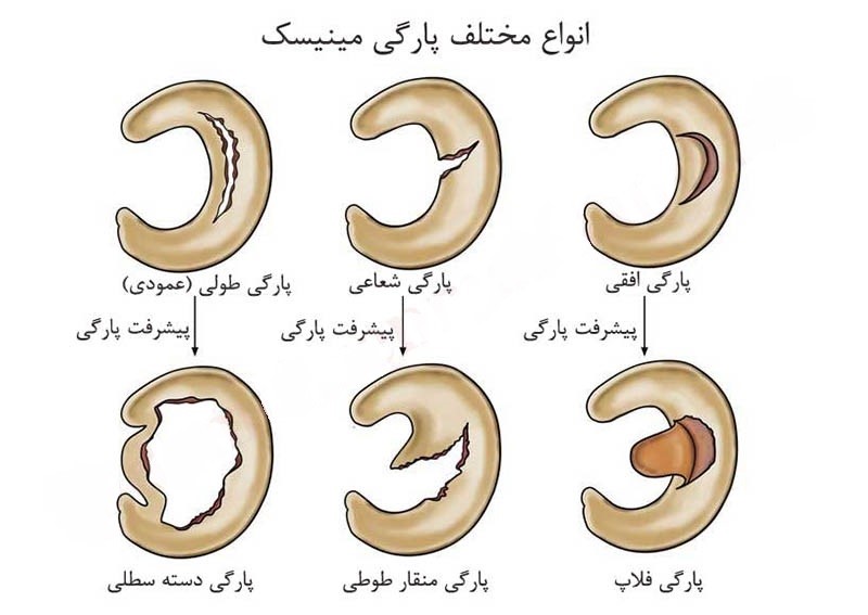 آیا عمل مینیسک زانو سخت است؟