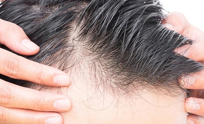 جدید ترین روش جلوگیری از ریزش مو