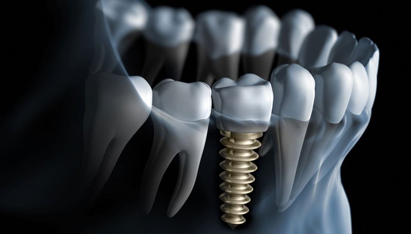 راهنمای انتخاب بهترین متخصص ایمپلنت دندان