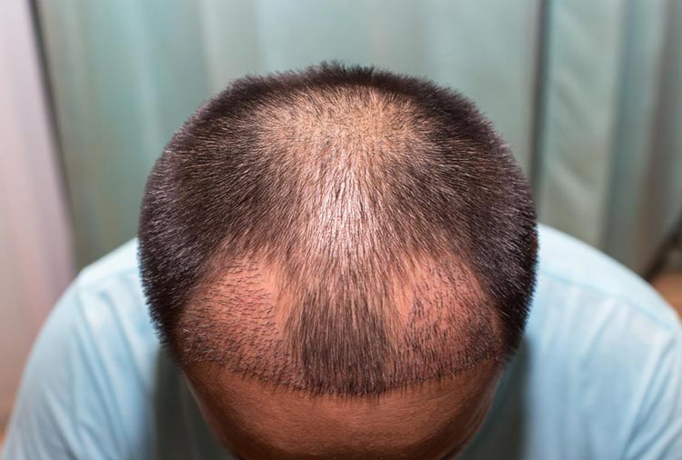 مراقبت های بعد از کاشت مو