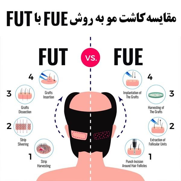 مقایسه کاشت مو به روش FUE با FUT