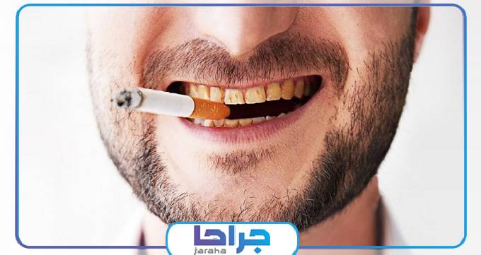 کامپوزیت روشی برای سفید کردن دندان افراد سیگاری