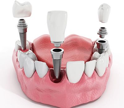 عوارض احتمالی ایمپلنت دندان