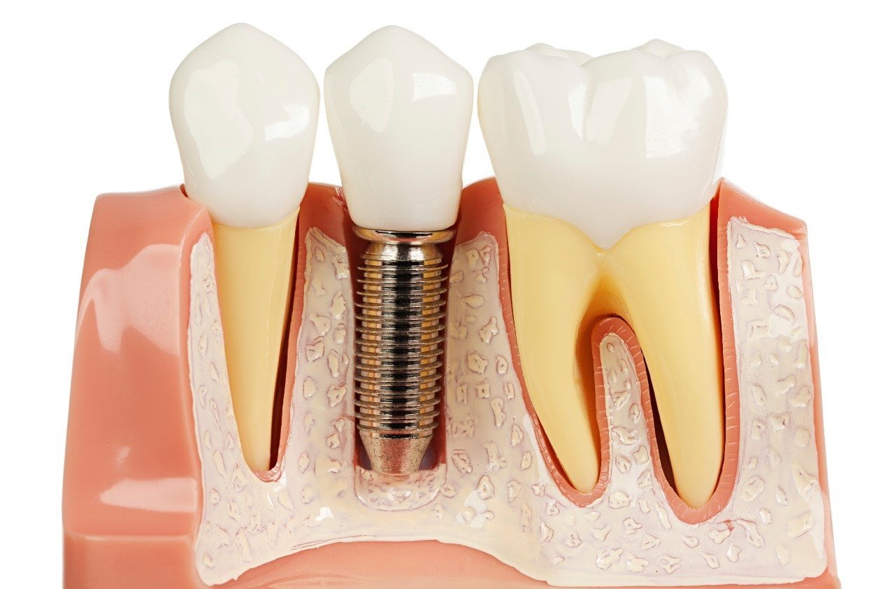 عوارض احتمالی ایمپلنت دندان