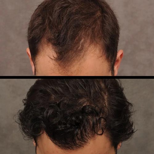 قبل و بعد از کاشت موی طبیعی