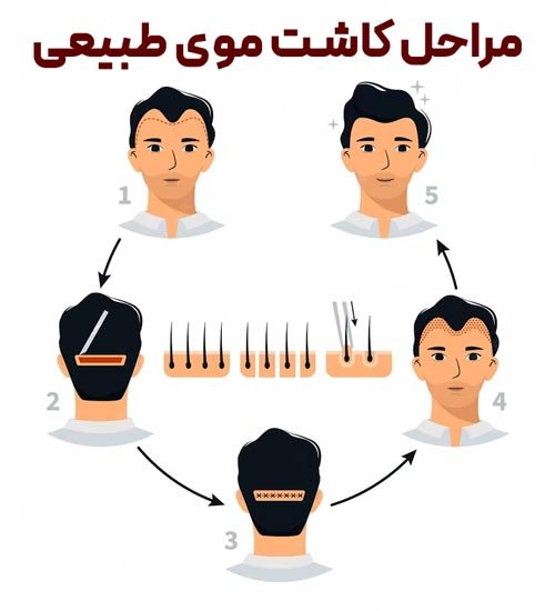 مراحل کاشت موی طبیعی