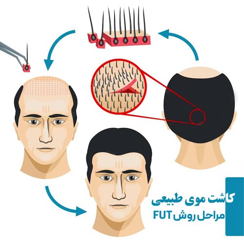 مراحل کاشت مو