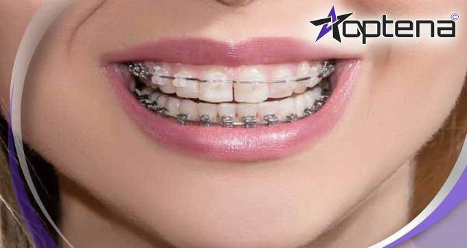 ارتودنسی چه تاثیری بر دندان ها می گذارد؟