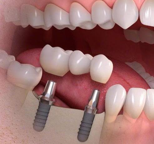 ایمپلنت دندان لیزری برای چه کسانی مناسب است؟