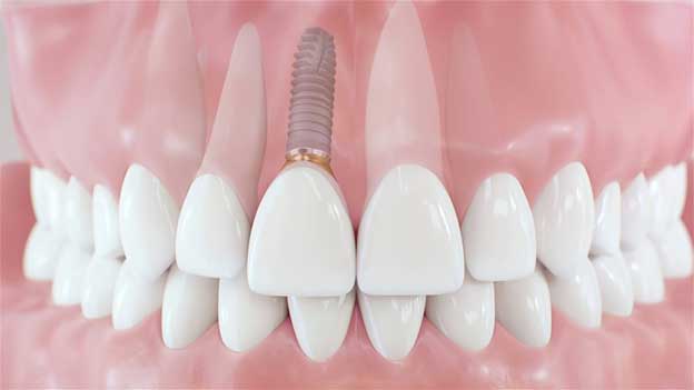 ایمپلنت دندان لیزری برای چه کسانی مناسب است؟