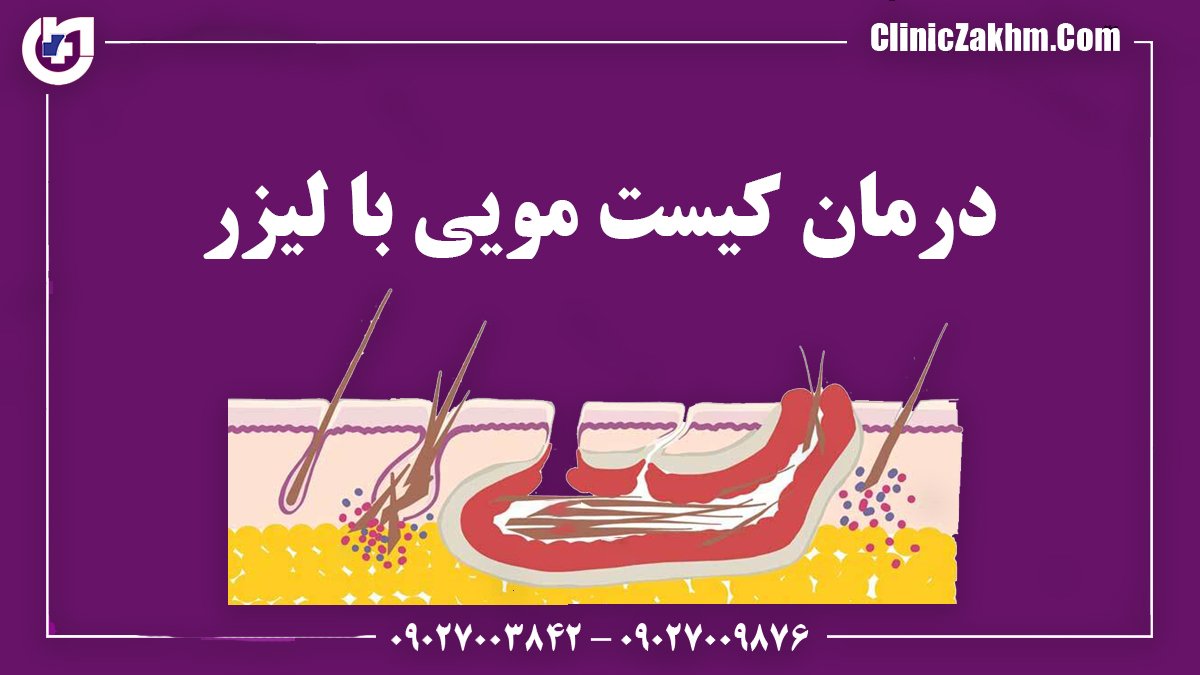 لیزر کیست مویی در تهران توسط پزشک متخصص