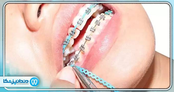 آیا کشیدن دندان برای ارتودنسی الزامی است؟