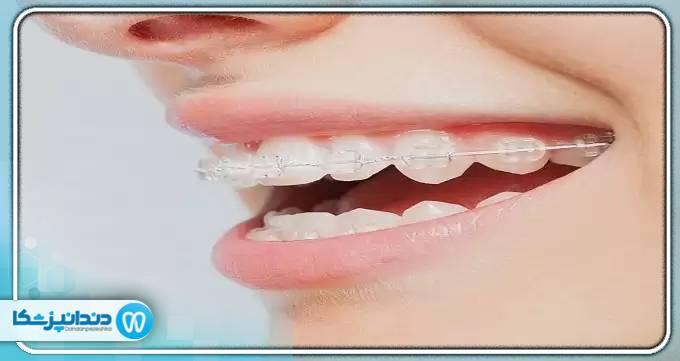 آیا کشیدن دندان برای ارتودنسی الزامی است؟