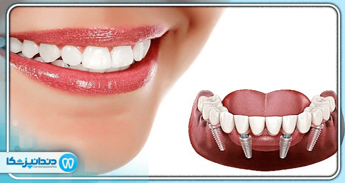 آیا ایمپلنت دندان روش دائمی است؟