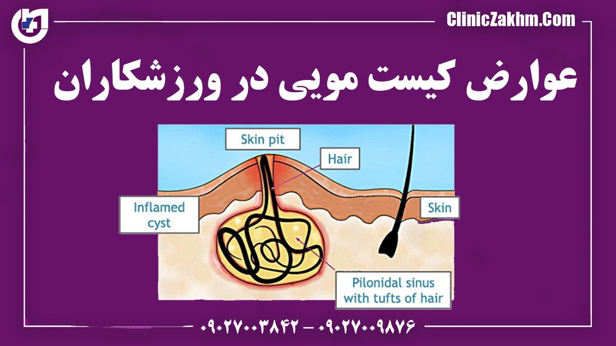 عوارض کیست مویی در ورزشکاران