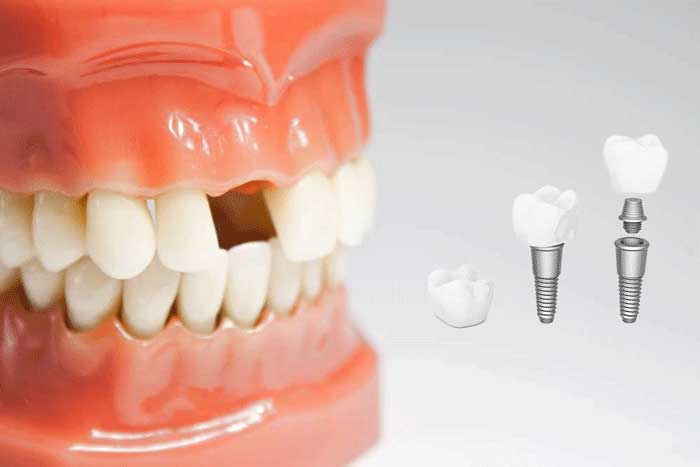 یک نمونه ایمپلنت دندان شامل پایه، پیچ و تاج