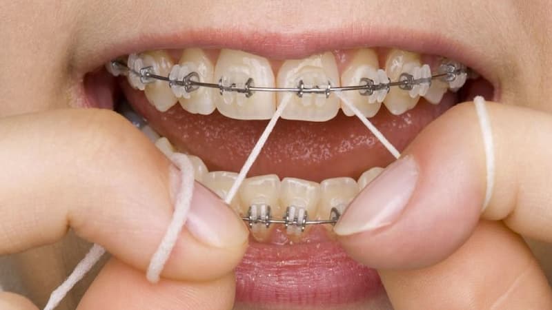 استفاده منظم از نخ دندان در ارتودنسی