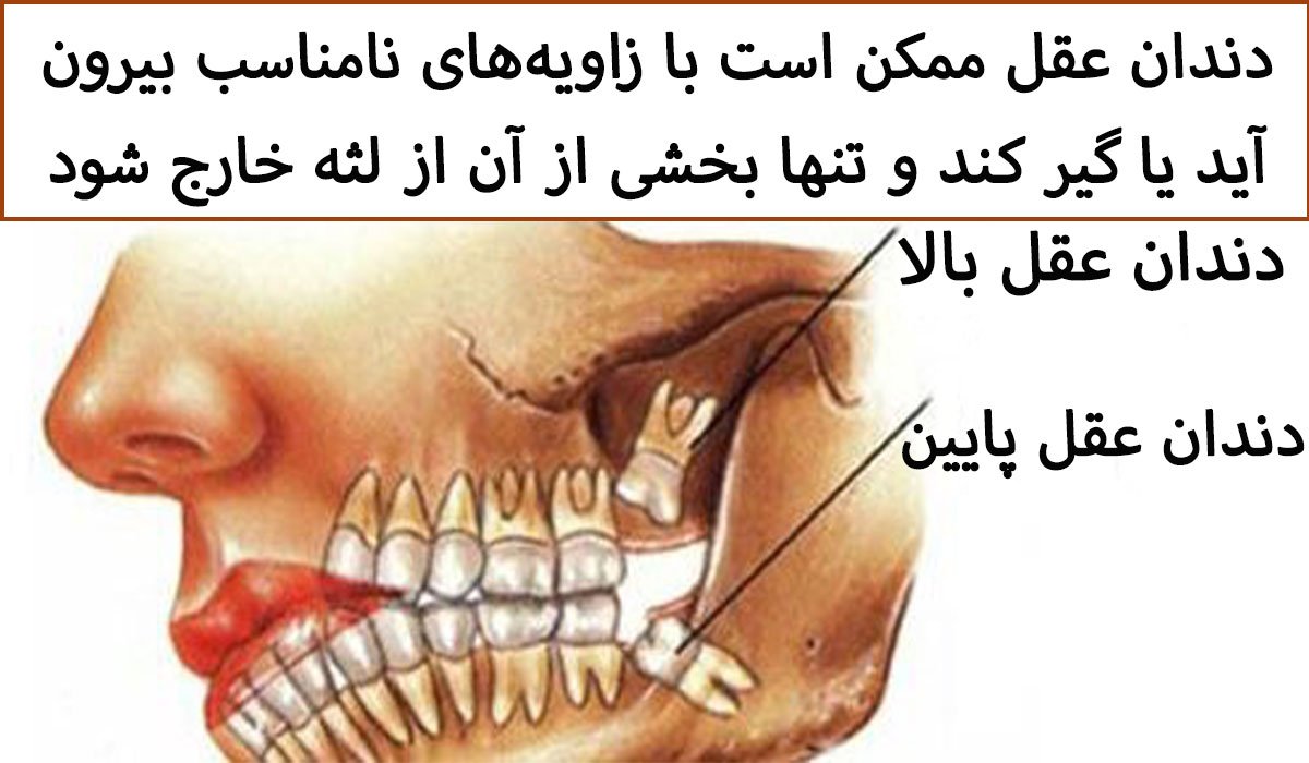 انواع دندان عقل