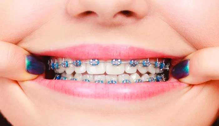 تعبیر ارتودنسی دندان