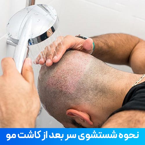 نحوه شستشوی بانک مو بعد از کاشت