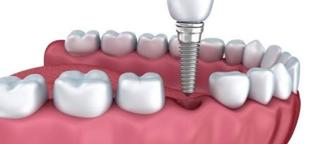 ایمپلنت دندان برای افراد دیابتی امکان پذیر است؟