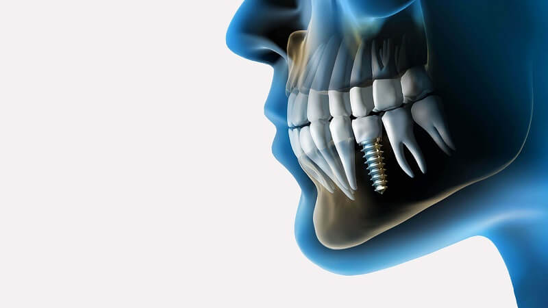 جویدن با دندان ایمپلنت چگونه است ؟