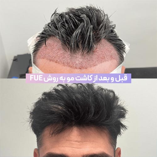 قبل و بعد از کاشت مو به روش FUE