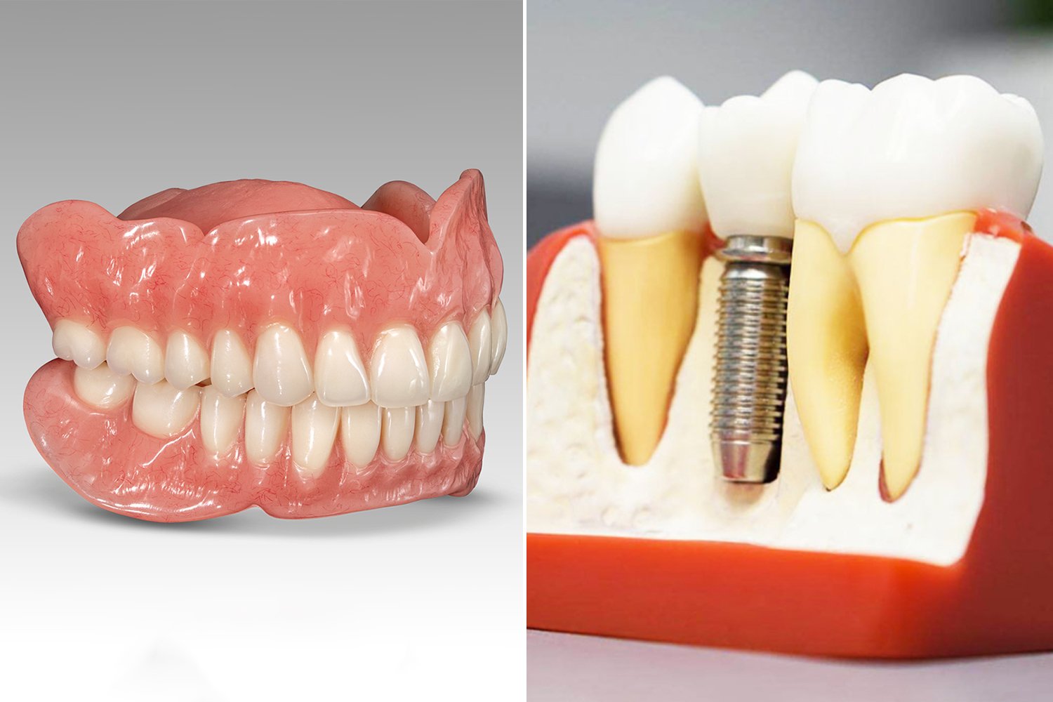 ایمپلنت دندان یا دندان مصنوعی