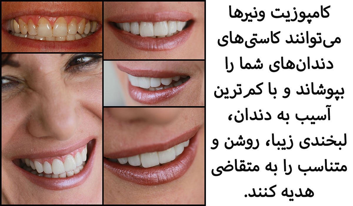 عکس قبل و بعد از کامپوزیت دندان برای سفید کردن دندانها