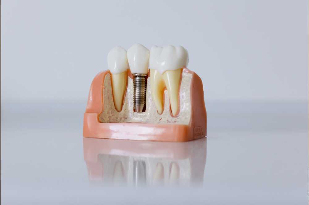 ایمپلنت دندان و عوارض آن