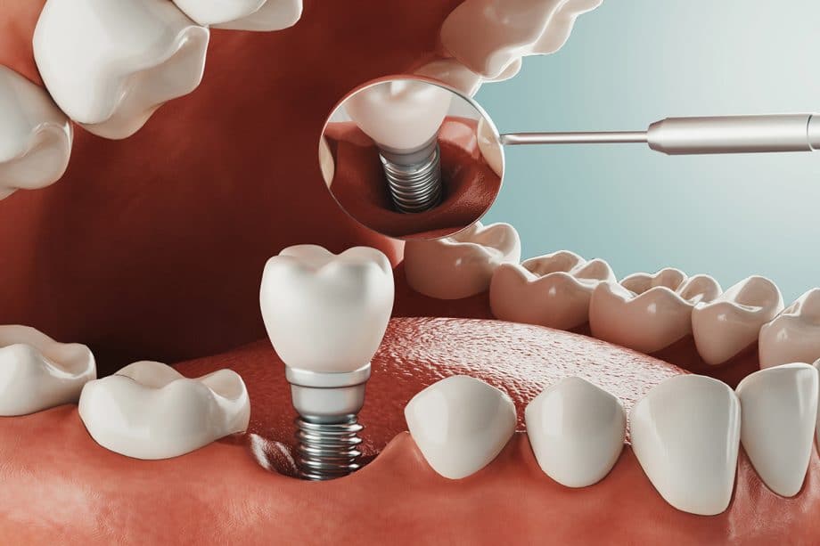 رایج ترین عوارض کاشت ایمپلنت دندان