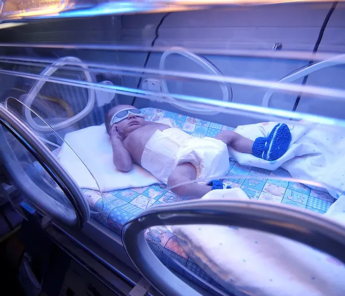 نوزاد مبتلا به زردی درحال فتوتراپی