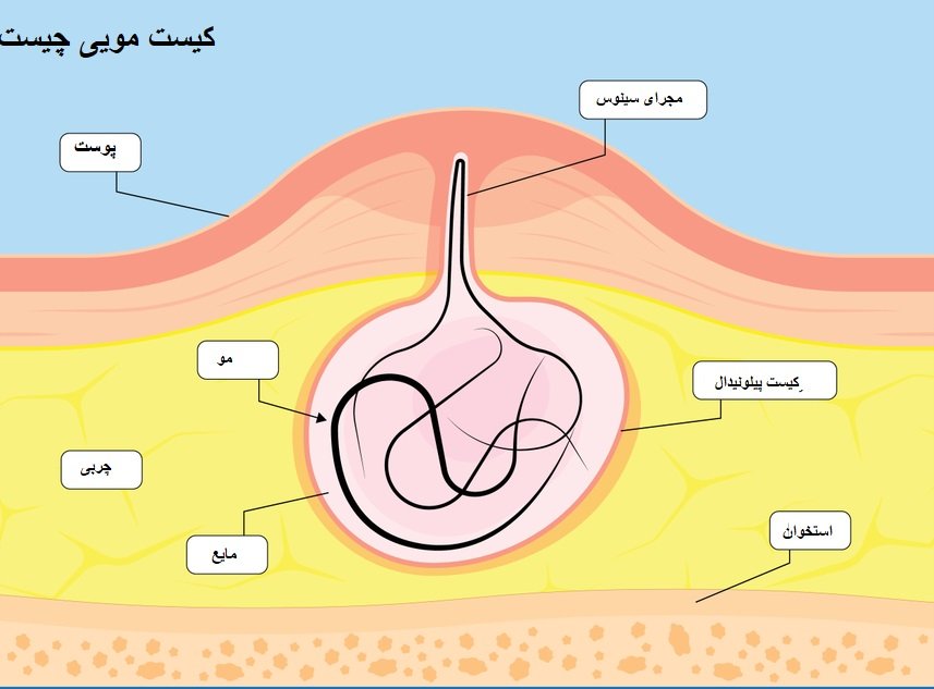 کیست مویی چیست
