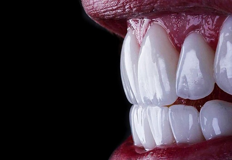 آیا قیمت لمینت دندان نسبت به مزایای آن توجیه‌پذیر است؟