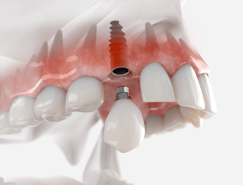 فاصلۀ بین کشیدن دندان و کاشت ایمپلنت چقدر است؟