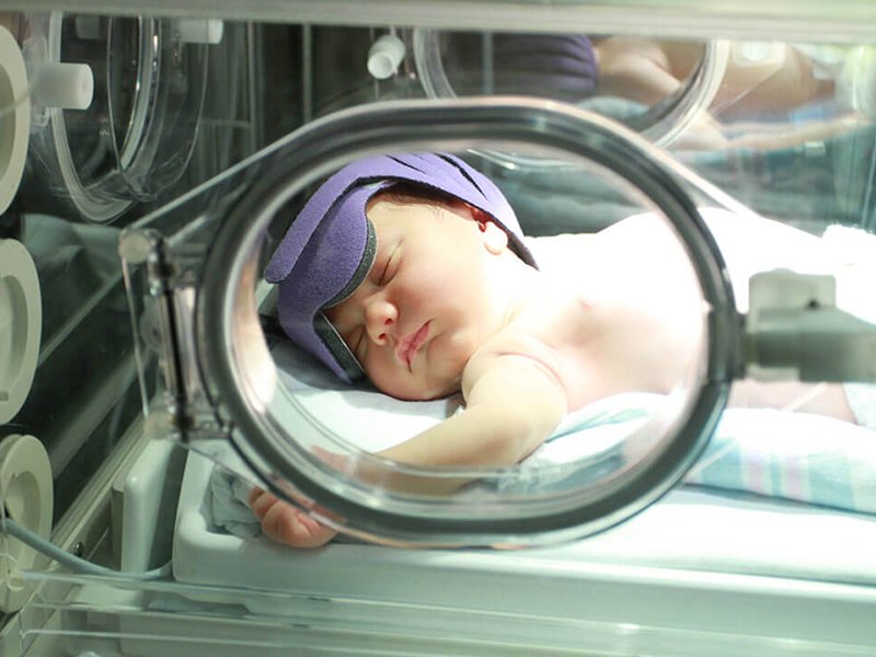 نوزاد مبتلا به بیماری زردی در دستگاه فتوتراپی