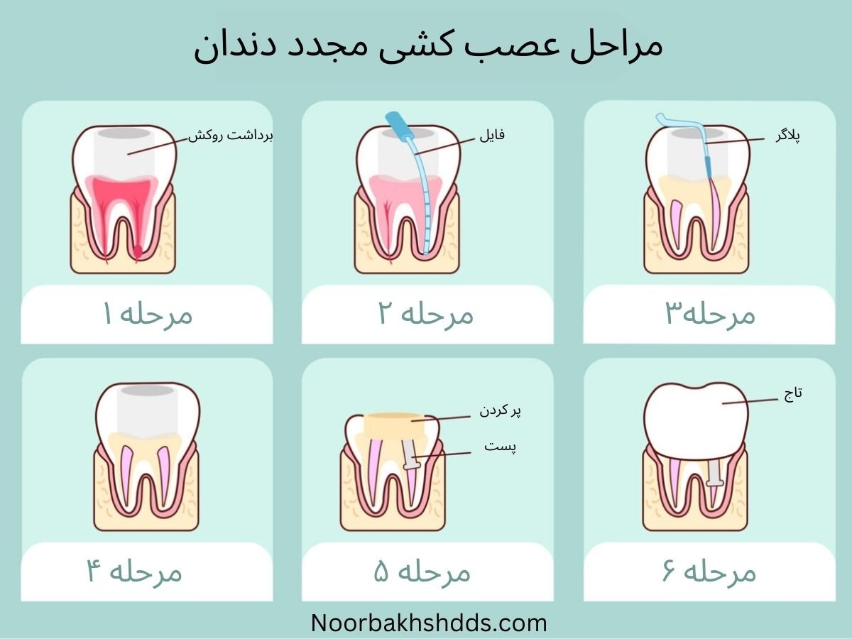 علت، مراحل، عوارض و مراقبت‌های درمان مجدد ریشه